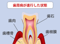 歯周病治療