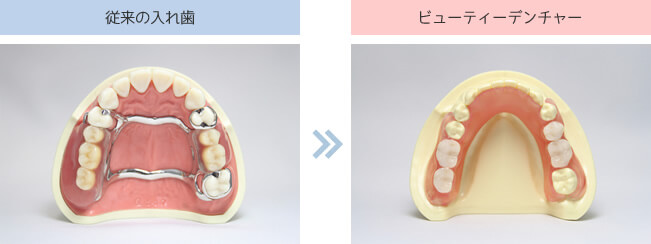 従来の入れ歯とビューティーデンチャーの比較1